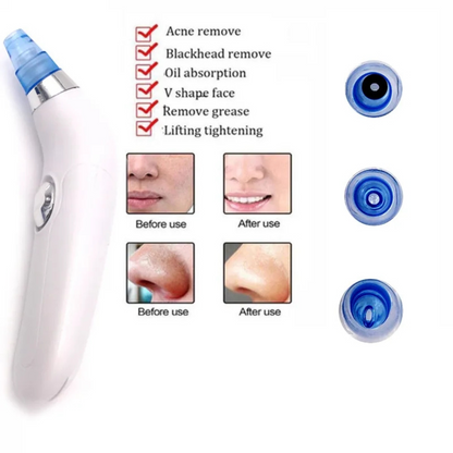 Derma Suction Blackhead Remover